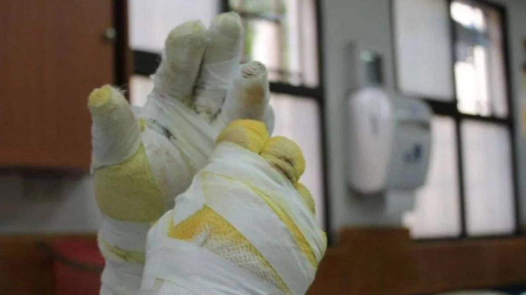 Aumentan las víctimas por pólvora en Cundinamarca: 41 lesionados en lo que va de diciembre